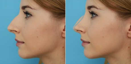 Ринопластика