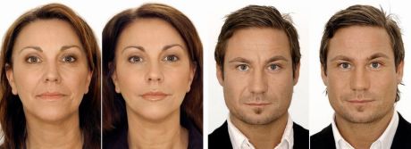 «RF»-лифтинг