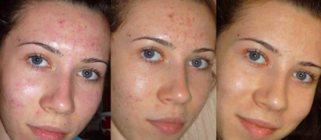 Лазерная чистка лица