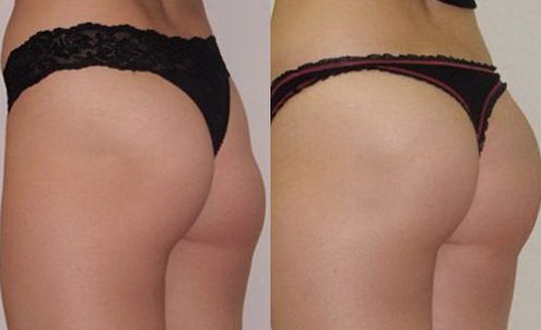 Глютеопластика ягодиц. Отзывы пациентов