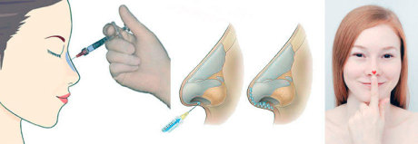 Как улучшить внешний вид с помощью ринопластики