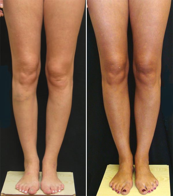 Круропластика голеней. Отзывы клиентов