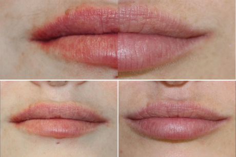 Липофилинг. Отзывы клиентов