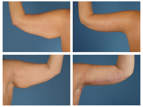 Брахиопластика, подтяжка кожи рук. Отзывы