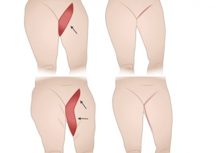 Подтяжка бедер. Отзывы