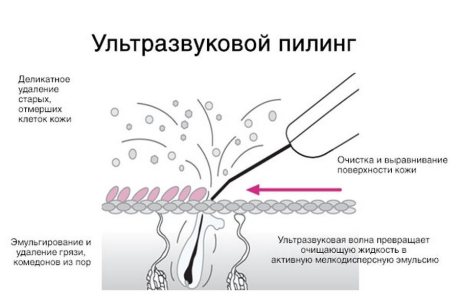 Чистка лица УЗИ