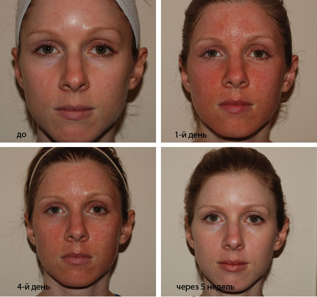 Как ухаживать за поверхностью кожи после Фракселя