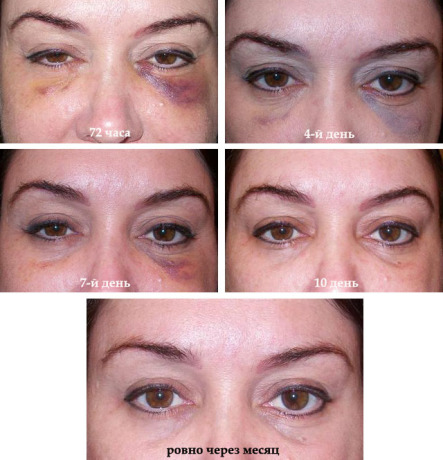 Чем опасны шишки и уплотнения после филлеров и как их убрать