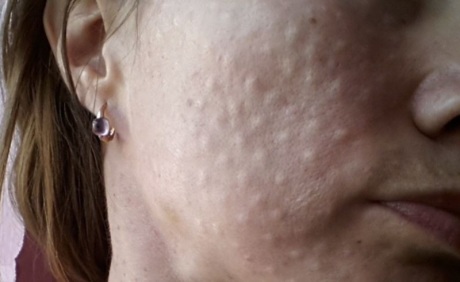 Чем опасны шишки и уплотнения после филлеров и как их убрать