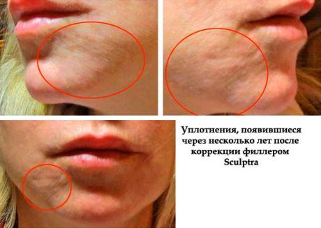 Чем опасны шишки и уплотнения после филлеров и как их убрать