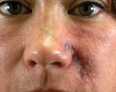 Возможные осложнения после контурной пластики