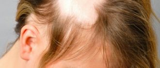Симптомы и варианты лечения облысения