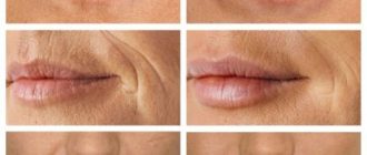 Reneall - линейка гиалуроновых монофазных филлеров отечественного производства