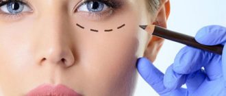 Блефаропластика – кардинальный способ улучшения кожного покрова вокруг глаз