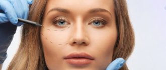 Коррекция формы скул