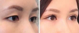 Пластика азиатских глаз, как один из популярных разделов пластической хирургии