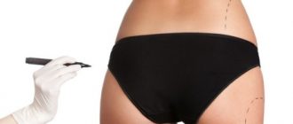 Липофилинг – способ скорректировать фигуру