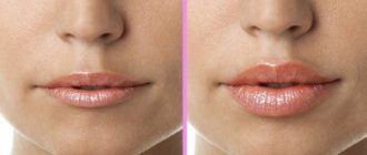 Пластика губ: особенности и разновидности вмешательства