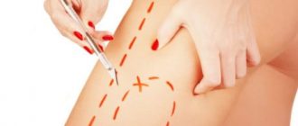 Хирургическая подтяжка кожного покрова на бедрах