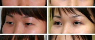 Блефаропластическая операция для азиатских глаз