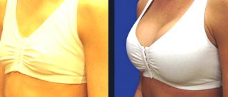 Увеличение груди: фото до и после