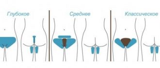 Интимная эпиляция в домашних условиях: как правильно удалять волосы в зоне бикини