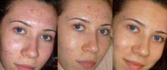 Лазерная чистка лица