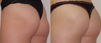 Глютеопластика ягодиц. Отзывы пациентов