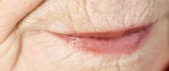 Морщины вокруг губ и мимические морщины вокруг рта: коррекция с помощью масок