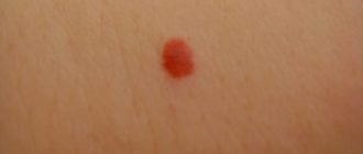 Красные папилломы: чем грозит и как лечить