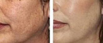 Желтый пилинг - звездный секрет красоты