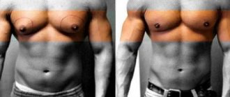 Гинекомастия у мужчин: формы заболевания и современные способы лечения