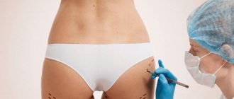 Процедура липофилинга для коррекции ягодиц