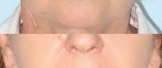 Глубокая шлифовка кожи лица лазером и в домашних условиях + фото отзывы