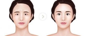 Лифтинг бровей и лба