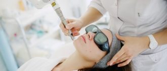 Лазерное лечение купероза