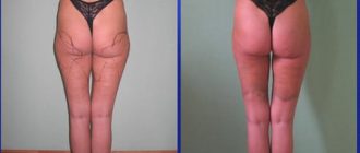 Липосакция бедер: сколько стоит липосакция внутренней поверхности бедер + фото