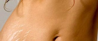 Крем от растяжек для беременных: лучшие марки + отзывы о результатах