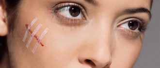 Келоидные рубцы: причины появления и лечение врачебными и народными средствами + фото