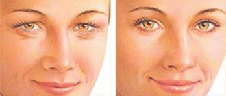 Корректировка глаз с помощью кантопексии и кантопластики