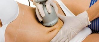 Ультразвуковая липосакция (кавитация)