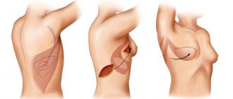 Варианты восстановления молочных желез