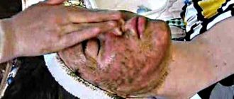 Коралловый пилинг - красивая кожа за неделю