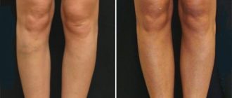 Круропластика голеней. Отзывы клиентов