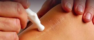 Лазерное удаление растяжек: почему удаление лазером эффективно + цена