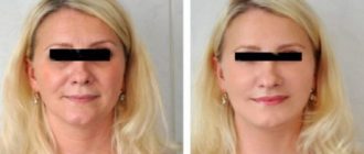 Лифтинг лица: профессиональные методы подтяжки кожи лица