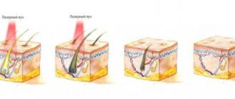 Плюсы и минусы лазерной эпиляции: все аргументы за и против процедуры