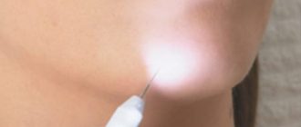 Электроэпиляция или лазерная эпиляция – что выбрать