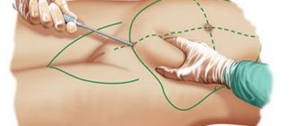 Липосакция живота хирургическая и безоперационная: фото до и послефото