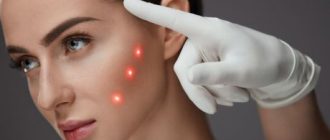 Аппаратная косметология в лице лазерного пилинга